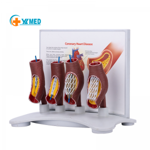 Model stent vaskular ilmu kedokteran Model pembuluh darah manungsa Model anatomi pembuluh darah patologis ngajar manungsa