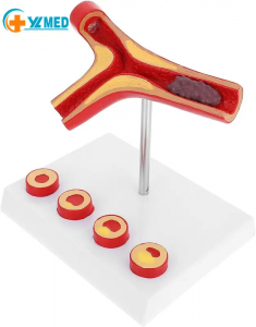 Modelo médico Cardiovascular de aterosclerosis humana, modelo anatómico de vasos sanguíneos, suministros de enseñanza médica para estudiantes escolares