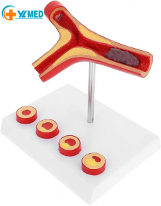 Human Atherosclerosis Cardiovascular Medical Model Blood Vessel Anatomical Model Lapaʻau aʻo Lapaʻau no nā haumāna kula.