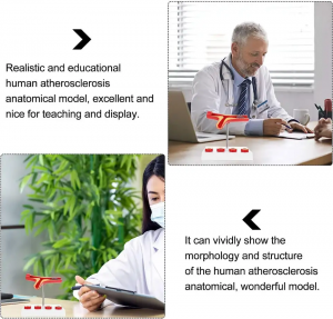 Human Atherosclerosis Cardiovascular Medical Model Blood Vessel Anatomical Model ອຸປະກອນການສອນທາງການແພດສໍາລັບນັກຮຽນໂຮງຮຽນ