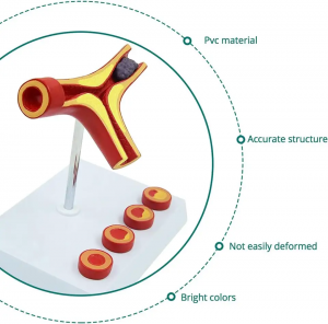 Žmogaus aterosklerozė Širdies ir kraujagyslių medicinos modelis Kraujagyslių anatominis modelis Medicinos mokymo reikmenys moksleiviams