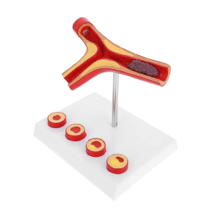Medical Science Human Arterial Thrombosis and Sclerosis Teaching Model Atherosclerosis Model