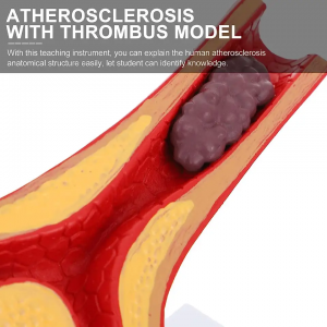 Modello medico cardiovascolare dell'aterosclerosi umana Modello anatomico del vaso sanguigno Materiale didattico medico per studenti scolastici