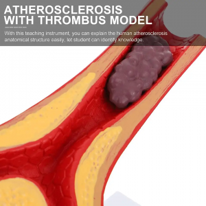 Human Atherosclerosis Cardiovascular Medical Model Blood Vessel Anatomical Model Lapaʻau aʻo Lapaʻau no nā haumāna kula.