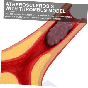 Human Atherosclerosis Cardiovascular Model Blood Vessel Anatomical Model 10 Times Heart Model Atherosclerosis Model