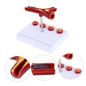 Human Atherosclerosis Cardiovascular Model Blood Vessel Anatomical Model 10 Times Heart Model Atherosclerosis Model