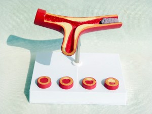 Human Atherosclerosis Cardiovascular Model Blood Vessel Anatomical Model 10 Times Heart Model Atherosclerosis Model