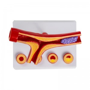 Human Atherosclerosis Cardiovascular Model Blood Vessel Anatomical Model 10 Times Heart Model Atherosclerosis Model