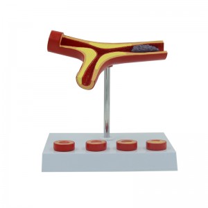 Human Atherosclerosis Cardiovascular Model Blood Vessel Anatomical Model 10 Times Heart Model Atherosclerosis Model