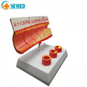 Factory price medical discipline coronary atherosclerotic with thrombus model anatomy teaching laboratory equipment