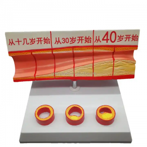 Factory price medical discipline coronary atherosclerotic with thrombus model anatomy teaching laboratory equipment